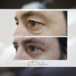 Blefaroplastia superior + inferior