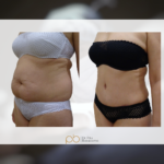 Liposucción + abdominoplastia