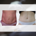 Abdominoplastia