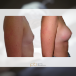 Augment de pit, pròtesis ergonòmiques