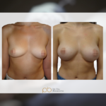 Aumento de pecho, prótesis anatómicas