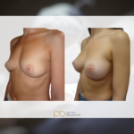 Aumento de pecho, prótesis anatómicas