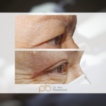 Blefaroplastia superior