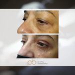 Blefaroplastia superior + inferior