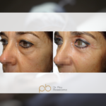 Blefaroplastia superior + inferior + lipotransferencia facial