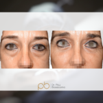 Blefaroplastia superior + inferior + lipotransferencia facial