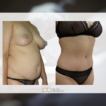 Lipoabdominoplastia