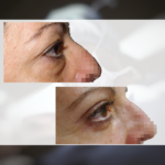 Blefaroplastia superior + inferior