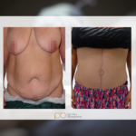 Abdominoplastia en flor de lis