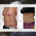 Abdominoplastia en flor de lis