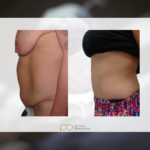 Abdominoplastia en flor de lis