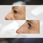 Blefaroplastia superior + inferior