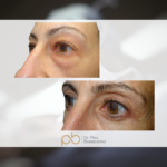 Blefaroplastia superior + inferior