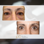 Blefaroplastia superior + inferior