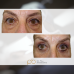Blefaroplastia superior + inferior