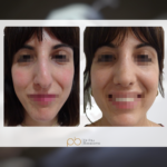 Rinoplastia