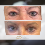 Blefaroplastia superior + inferior