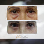 Blefaroplastia superior + inferior